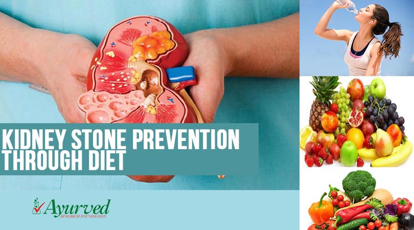 Kidney Stone Prevention through Diet