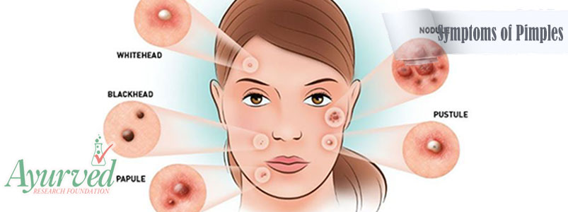 Symptoms of Pimples