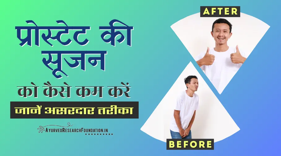प्रोस्टेट की सूजन को कैसे कम करें, प्रोस्टेट सूजन की दवा, prostate ki sujan ko kaise kam kare